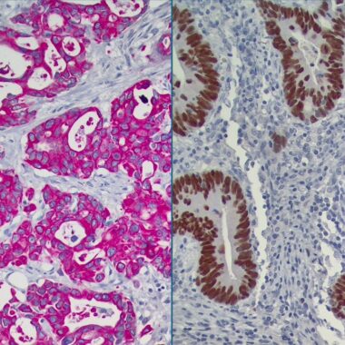Anti-Unknown Primary Cocktail antibody (Full Length) [CK7 (ZR428) + CDX-2 (ZM20)] IHC antibody paraffin tissue