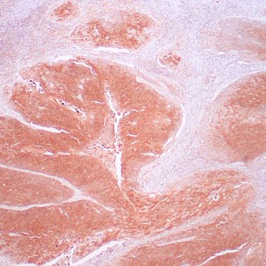 Anti-HPV antibody [CAMVR-1&C1P5] IHC antibody paraffin tissue