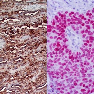 Anti-Lung cocktail antibody [P40 (ZR8) + napsin A (ZM11)] IHC antibody paraffin tissue