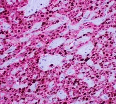 Anti-HPV infection Tumor cocktail antibody (Full Length) [P16 (ZR407) + Ki-67 (ZM67)] IHC antibody paraffin tissue
