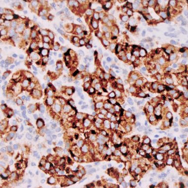 Anti-Melanosome antibody [HMB‐45] IHC antibody paraffin tissue