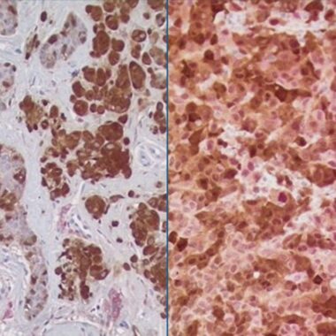 Anti-Malanoma cocktail antibody (100-509) [PRAME (ZR383) + S-100 (4C4.9)] IHC antibody paraffin tissue